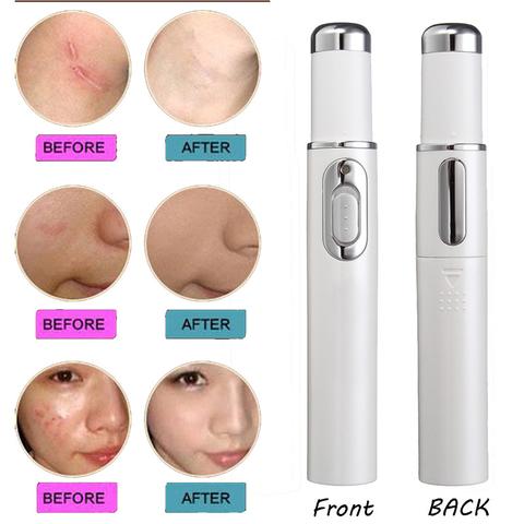 Blue Light Therapy Acne Soft Scar Wrinkle Pen Laser Removal Treatment Device